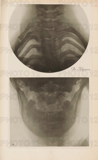 X-ray of ribs, photograph, page, name: 'Dr. Heilporn', c. 1904 - in or before 1909, photographer,