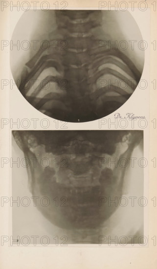 X-ray of an upper and lower jaw, photograph, page, name: 'Dr. Klynens.', c. 1904 - in or before