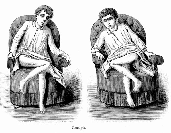 Coxalgia ( Tuberculosis of the hip ). Weekly magazine " Illustrated medecine "
by Dr. Gerard.