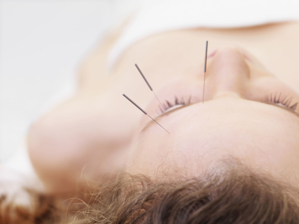 Woman receiving acupuncture. Date : 2008