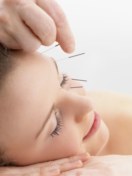 Woman receiving acupuncture. Date : 2008
