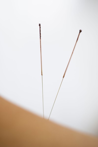 Acupuncture needles.