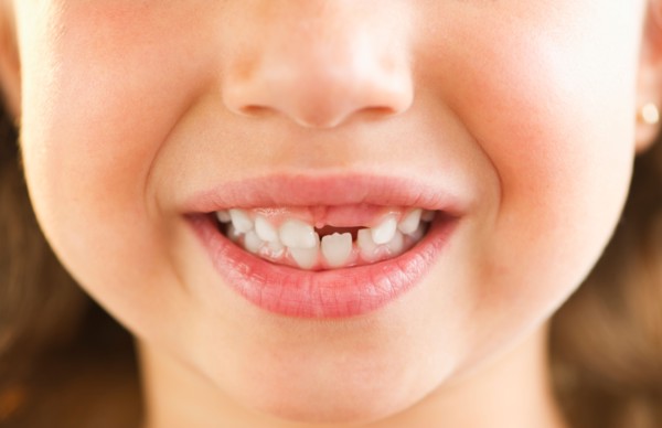 Close-up of girl's (2-3) mouth with some teeth missing. Photo : Daniel Grill