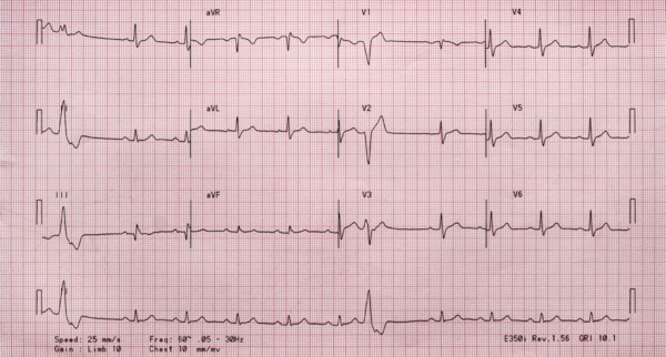 Electrocardiogram on red graph paper