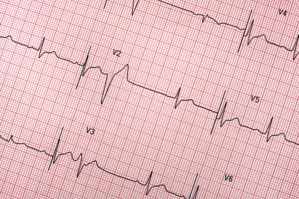 Electrocardiogram on red graph paper