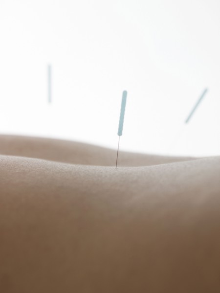 Close up of acupuncture needles in back of woman