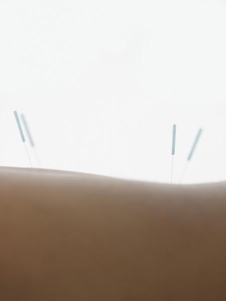 Close up of acupuncture needles in back of woman