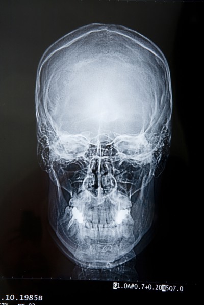 Close up of x-ray of skull