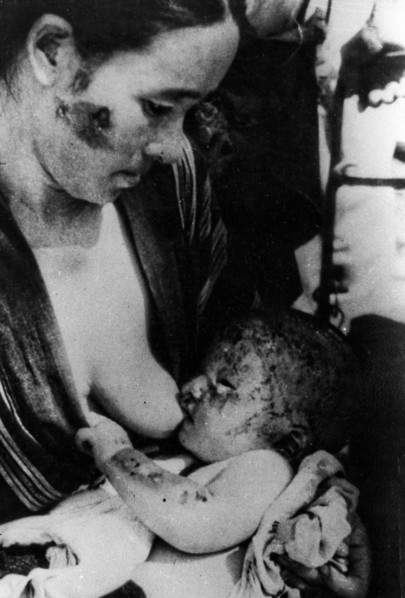 Mother And Son After The Atomic Explosion In Nagasaki.