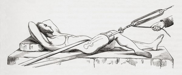 Reduction of dislocated thigh using pulleys.