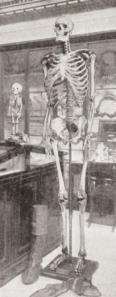 The skeletons of Charles Byrne.