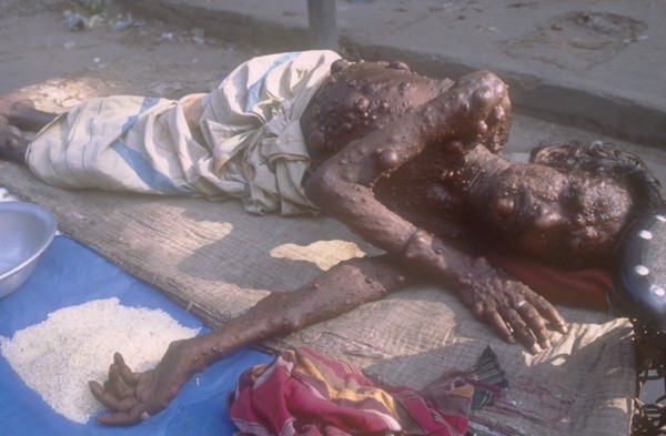 BANGLADESH, Dhaka, Elderly man suffering from a medical condition called Neurofibromatosis