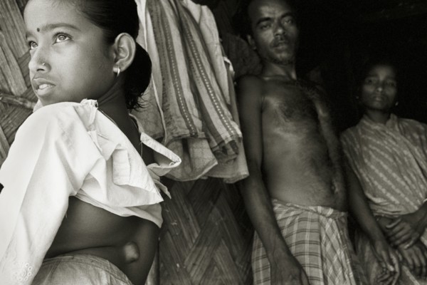 INDIA, West Bengal, Mal, Parents display a growth on their daughter's spine in a West Bengal