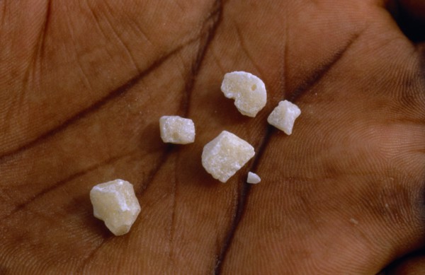 COLOMBIA, Vaupes, "Crystalized cocaine base displayed on palm of hand in illegal lab. in Vaupes