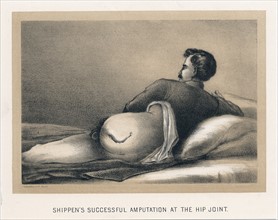 Successful amputation at the hip joint on casualty in American Civil War