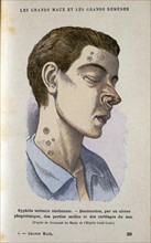 Man suffering from tertiary Syphilis