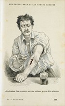 Painting a wound with an antiseptic solution