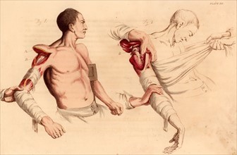 Amputation of the arm at the shoulder