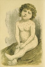 Enfant souffrant de la rougeole