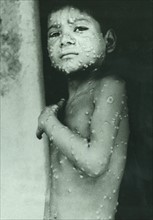 Last indigenous case of Smallpox in India, Katihar District, Eihar State