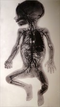 X-Ray depicting the injected arterial vessel system of a nine-month-old foetus 1908