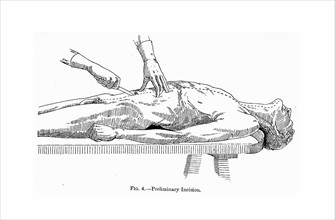 Line drawing depicting a preliminary incision