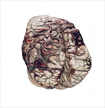 Colour illustration of a gunshot-wound in the brain