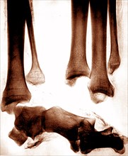X-ray images of the legs of an ancient Egyptian mummy created soon after the announcement of Wilhelm Röntgen's discovery of X-rays