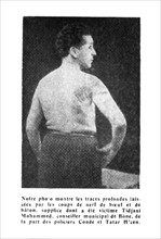 January 1933, traces of flogging on Mr. Mohammed Tidjani's back, town councillor of Bône, inflicted by policemen