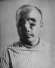 Soldat allemand, dont le visage a été détruit par l'explosion d'un obus