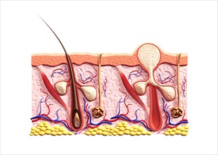 Cross section of skin showing structure of a healthy hair follicle with and sebaceous glands and a whitehead acne pimple filled with sebum