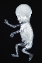 X-ray of a baby