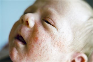 Newborn baby boy face with many red pimples caused by atopic dermatitis