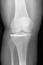 X-ray of a patient after tibial plateau fracture with 2 screws