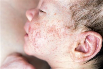 Newborn baby with many red spots caused by neurodermatitis
