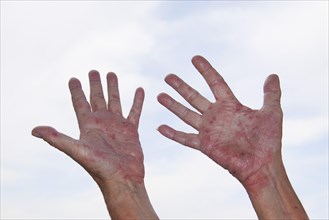 Patient with Atopic dermatitis or endogenous eczema