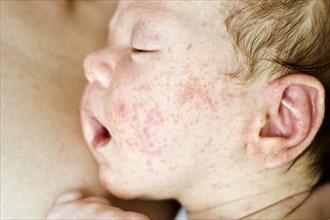 Newborn baby boy face with many red pimples caused by atopic dermatitis