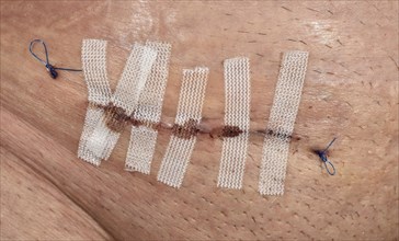 Stitched wound suture with filaments and Steristrips after hernia surgery