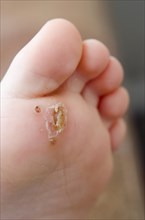 Verruca plantar wart on a child's foot