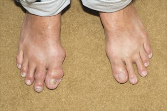 Male foot with gout