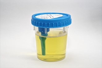 Urine sample in beaker for examination
