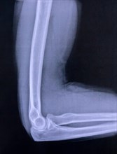 X-ray image of elbow and upper arm