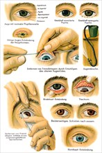 Various eye diseases