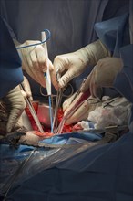 Surgeons perform a hysterectomy on a woman with endometrial cancer at Karmanos Cancer Institute