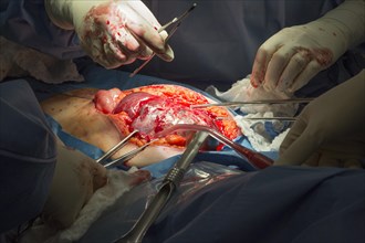 Surgeons perform a hysterectomy on a woman with endometrial cancer at Karmanos Cancer Institute