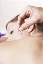 Young woman receiving acupuncture treatment on her back