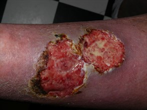Arteriovenous leg ulcers with super-infection and malignancy