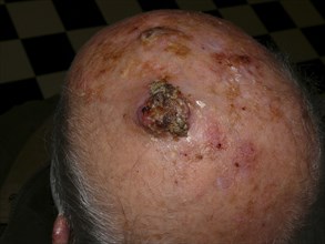 Squamous-cell carcinoma of the scalp