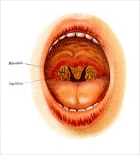 Diphtheria of the tonsils and uvula