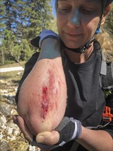 Female mountain biker looking at her bleeding graze on her forearm after a fall